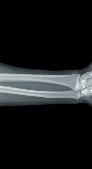 xrayarmandhand