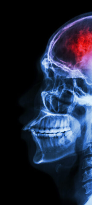 strokeimage