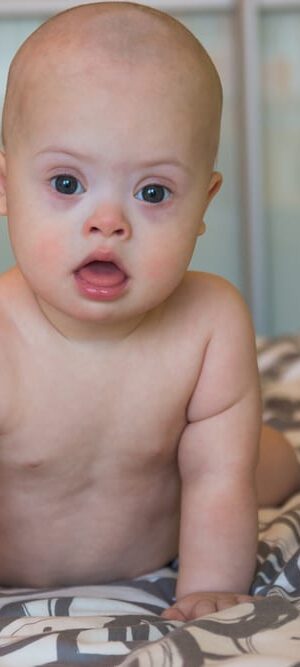 baby with downs syndrome