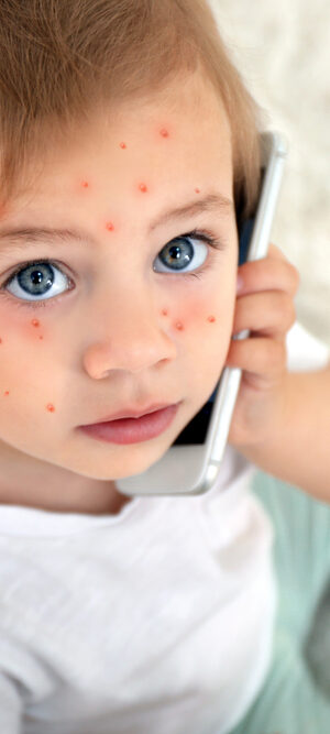 child with varicella