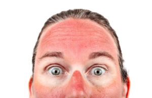 person with sunburn on face