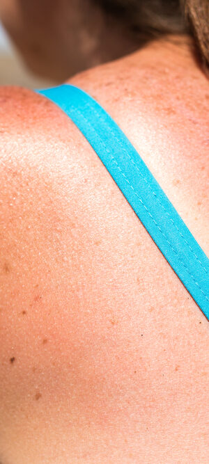 sunburn on young woman